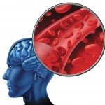 moždani udar usled pucanja aneurizme